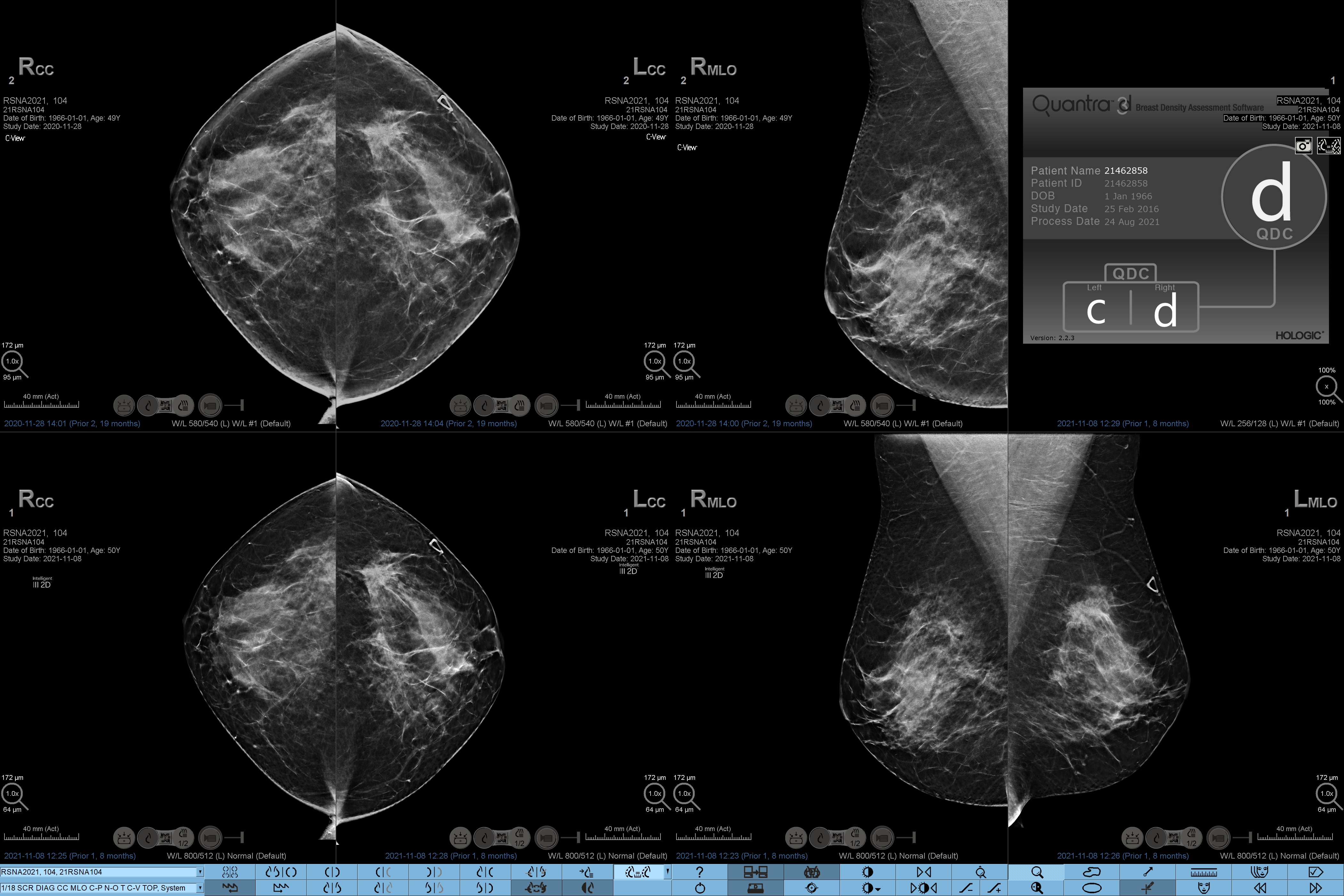 Quantra® 2.2 | Breast Density Assessment Software | Hologic